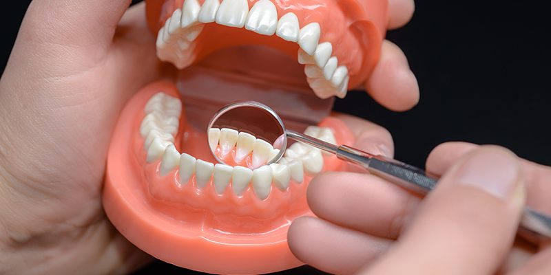 Partial Dentures